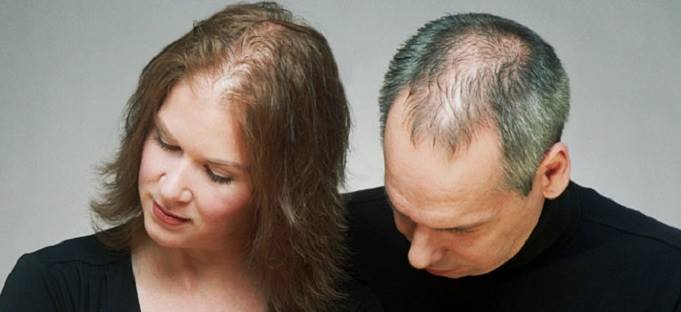 hormonális hajhullás (alopecia androgenetica)