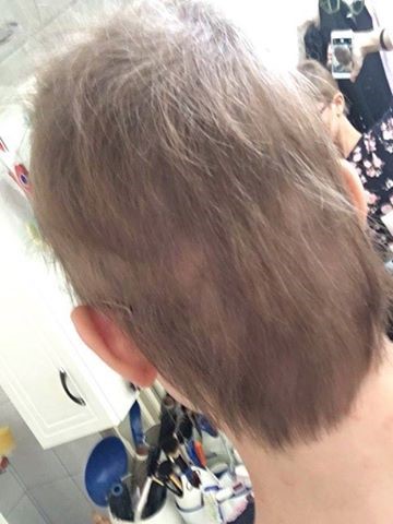 SLE szisztémás lupus erit hajhullás
